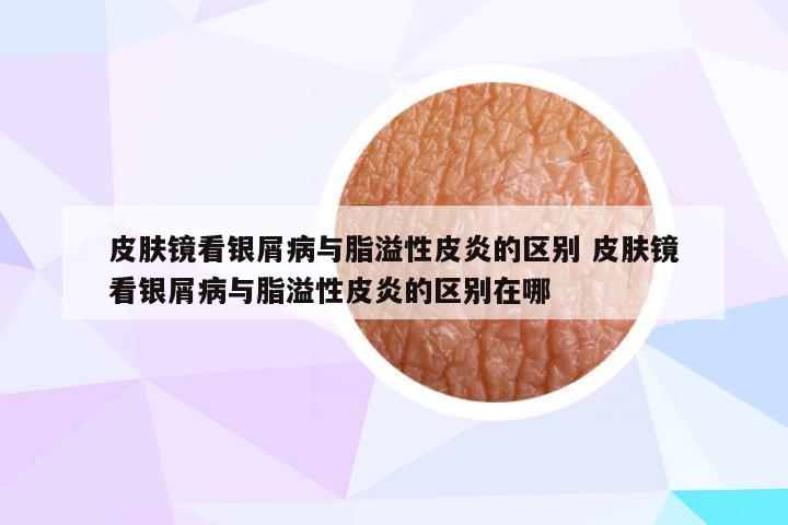皮肤镜看银屑病与脂溢性皮炎的区别 皮肤镜看银屑病与脂溢性皮炎的区别在哪