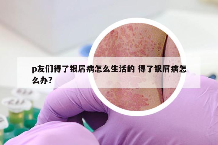 p友们得了银屑病怎么生活的 得了银屑病怎么办?