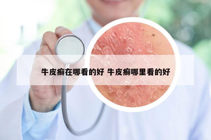 牛皮癣在哪看的好 牛皮癣哪里看的好
