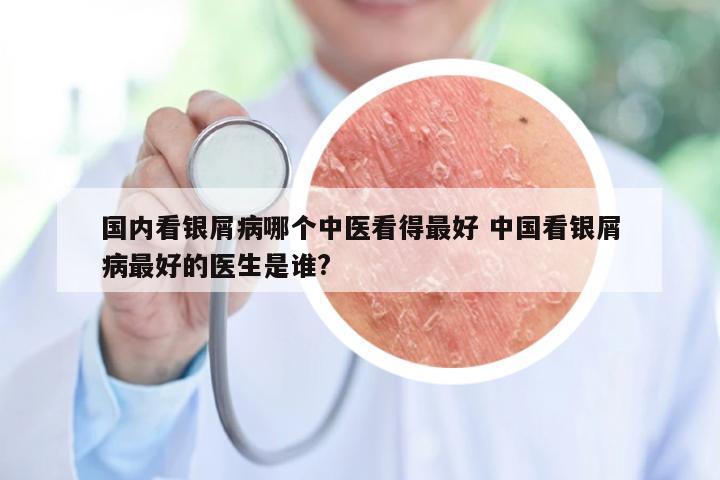 国内看银屑病哪个中医看得最好 中国看银屑病最好的医生是谁?
