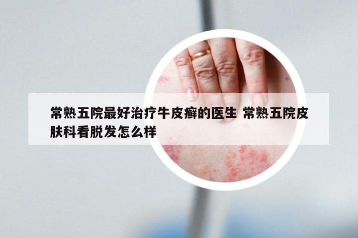 常熟五院最好治疗牛皮癣的医生 常熟五院皮肤科看脱发怎么样