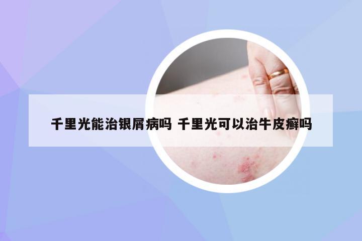 千里光能治银屑病吗 千里光可以治牛皮癣吗