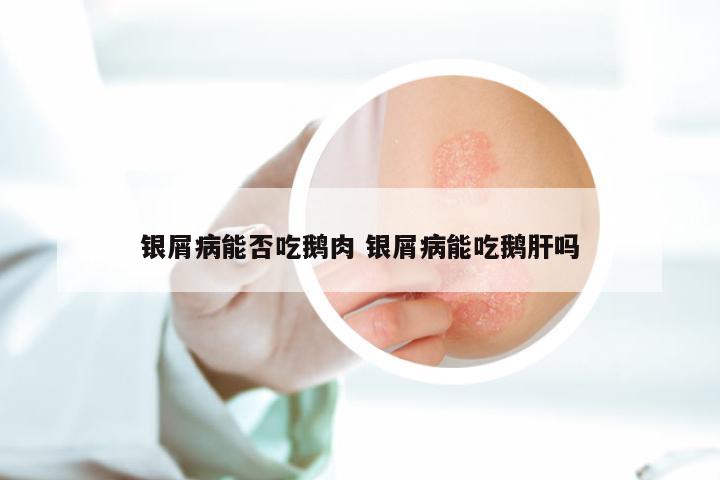 银屑病能否吃鹅肉 银屑病能吃鹅肝吗