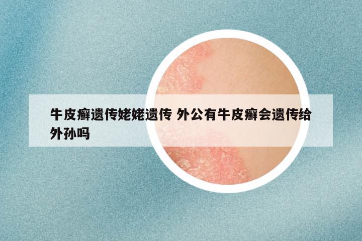 牛皮癣遗传姥姥遗传 外公有牛皮癣会遗传给外孙吗
