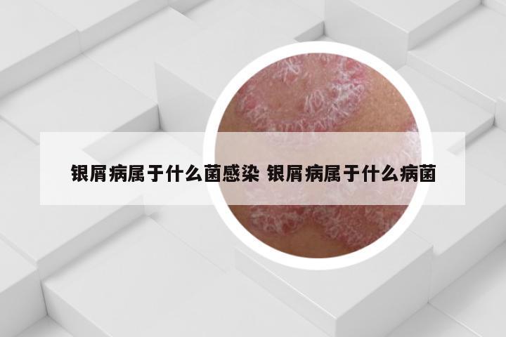 银屑病属于什么菌感染 银屑病属于什么病菌