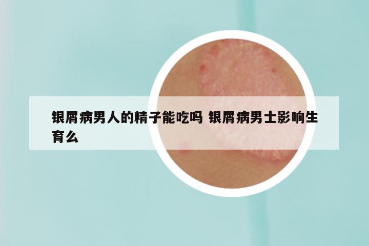 银屑病男人的精子能吃吗 银屑病男士影响生育么