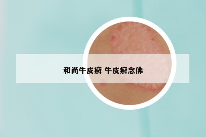 和尚牛皮癣 牛皮癣念佛