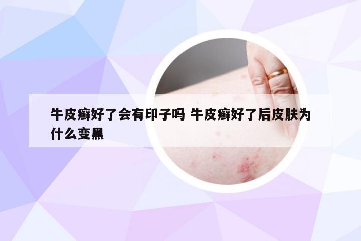 牛皮癣好了会有印子吗 牛皮癣好了后皮肤为什么变黑
