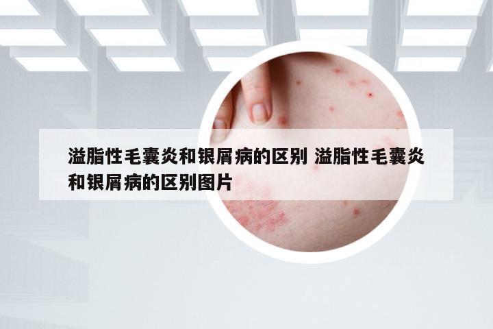 溢脂性毛囊炎和银屑病的区别 溢脂性毛囊炎和银屑病的区别图片
