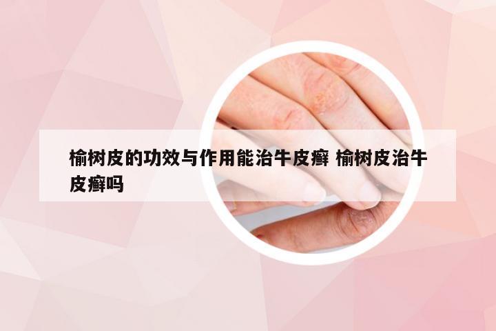 榆树皮的功效与作用能治牛皮癣 榆树皮治牛皮癣吗