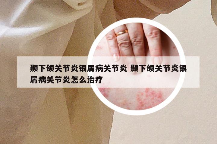 颞下颌关节炎银屑病关节炎 颞下颌关节炎银屑病关节炎怎么治疗