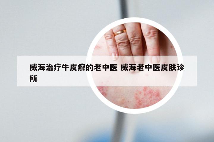 威海治疗牛皮癣的老中医 威海老中医皮肤诊所
