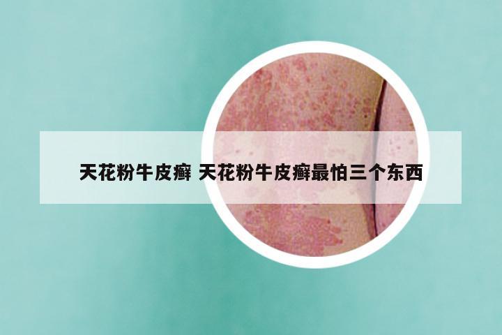 天花粉牛皮癣 天花粉牛皮癣最怕三个东西