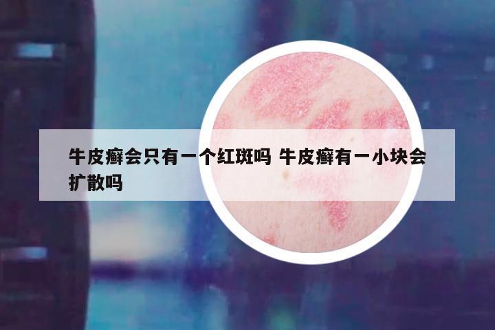 牛皮癣会只有一个红斑吗 牛皮癣有一小块会扩散吗