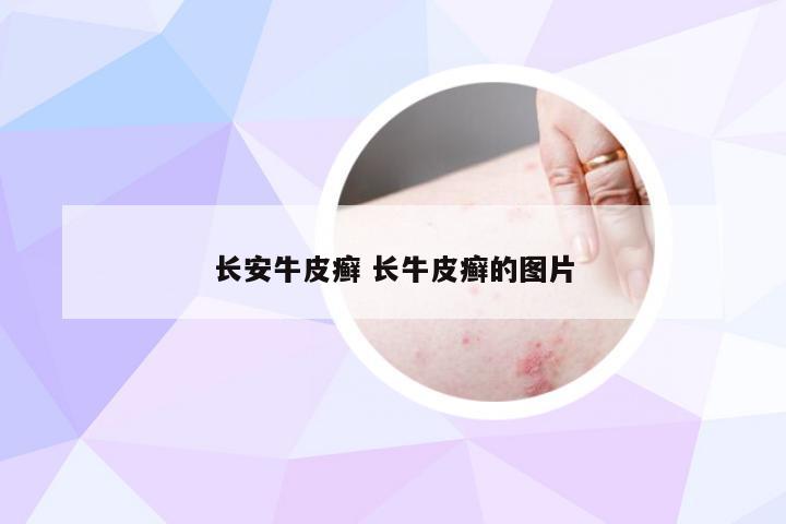 长安牛皮癣 长牛皮癣的图片