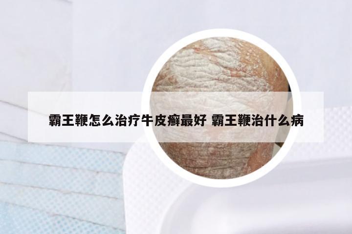 霸王鞭怎么治疗牛皮癣最好 霸王鞭治什么病