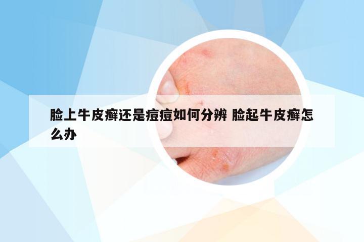 脸上牛皮癣还是痘痘如何分辨 脸起牛皮癣怎么办