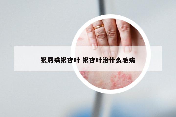银屑病银杏叶 银杏叶治什么毛病