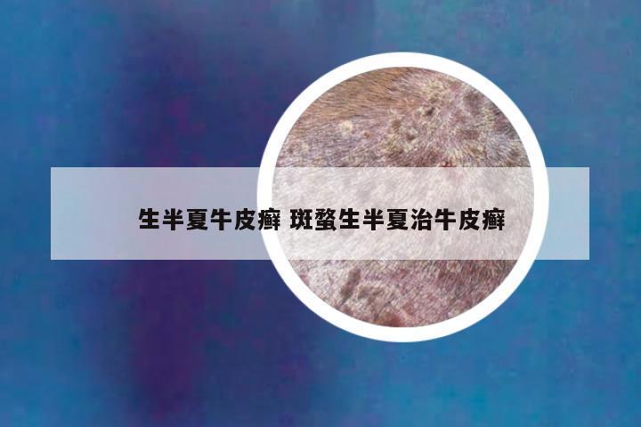 生半夏牛皮癣 斑蝥生半夏治牛皮癣