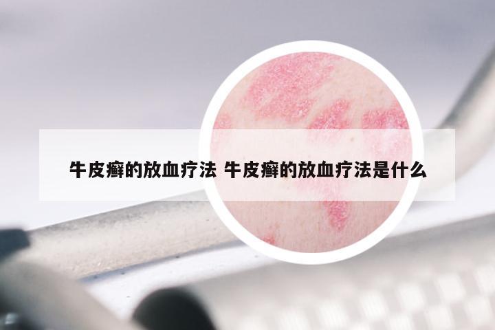 牛皮癣的放血疗法 牛皮癣的放血疗法是什么