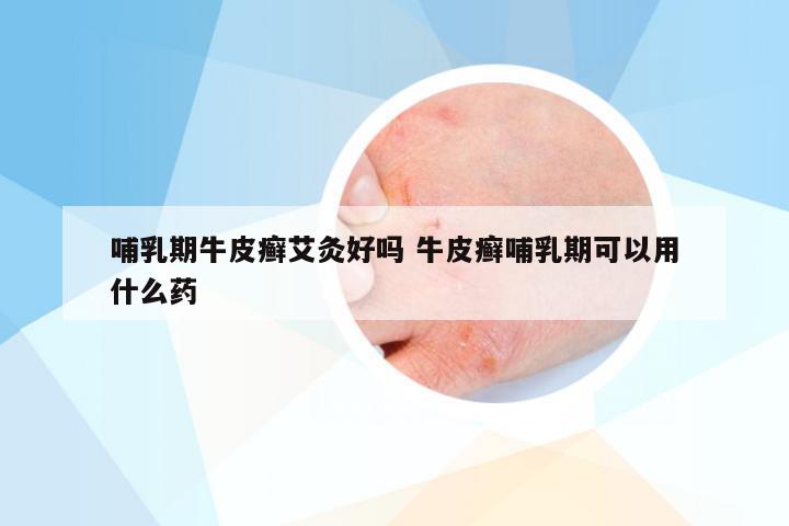 哺乳期牛皮癣艾灸好吗 牛皮癣哺乳期可以用什么药