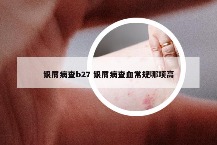 银屑病查b27 银屑病查血常规哪项高