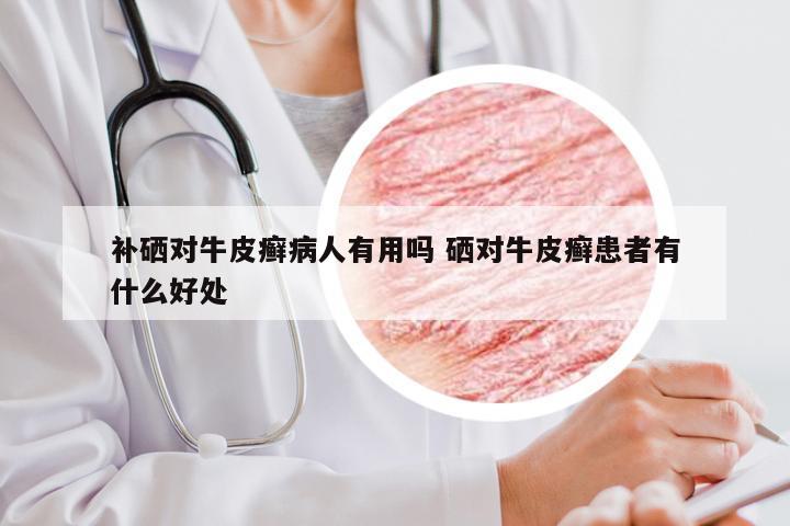 补硒对牛皮癣病人有用吗 硒对牛皮癣患者有什么好处