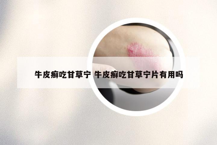牛皮癣吃甘草宁 牛皮癣吃甘草宁片有用吗