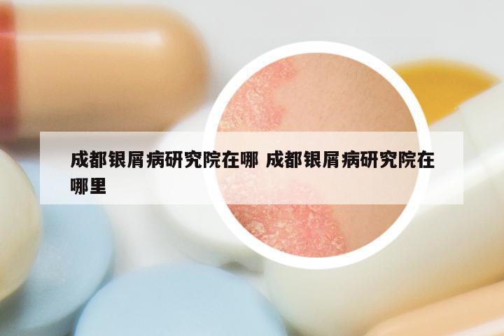 成都银屑病研究院在哪 成都银屑病研究院在哪里