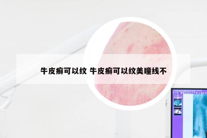 牛皮癣可以纹 牛皮癣可以纹美瞳线不