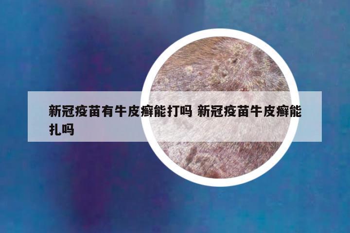新冠疫苗有牛皮癣能打吗 新冠疫苗牛皮癣能扎吗