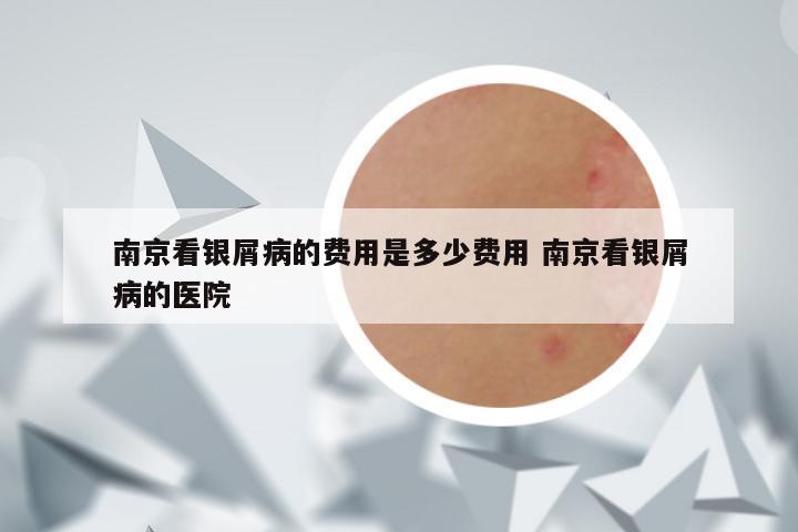 南京看银屑病的费用是多少费用 南京看银屑病的医院