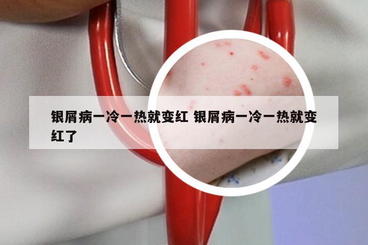 银屑病一冷一热就变红 银屑病一冷一热就变红了