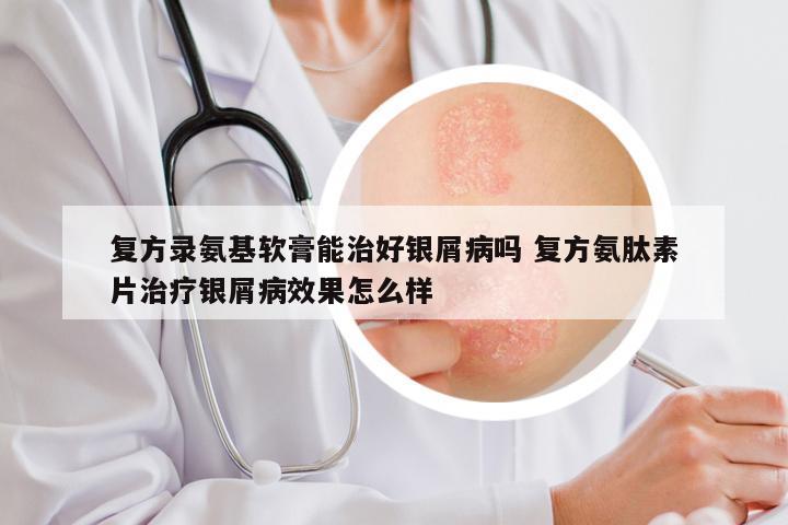 复方录氨基软膏能治好银屑病吗 复方氨肽素片治疗银屑病效果怎么样