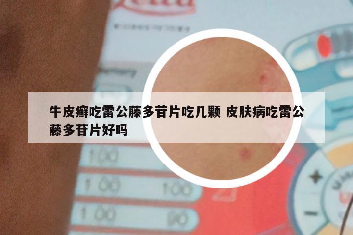 牛皮癣吃雷公藤多苷片吃几颗 皮肤病吃雷公藤多苷片好吗