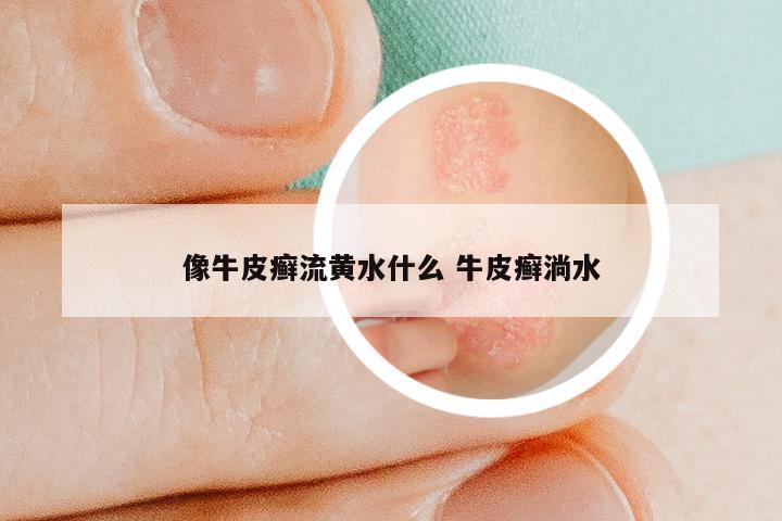 像牛皮癣流黄水什么 牛皮癣淌水
