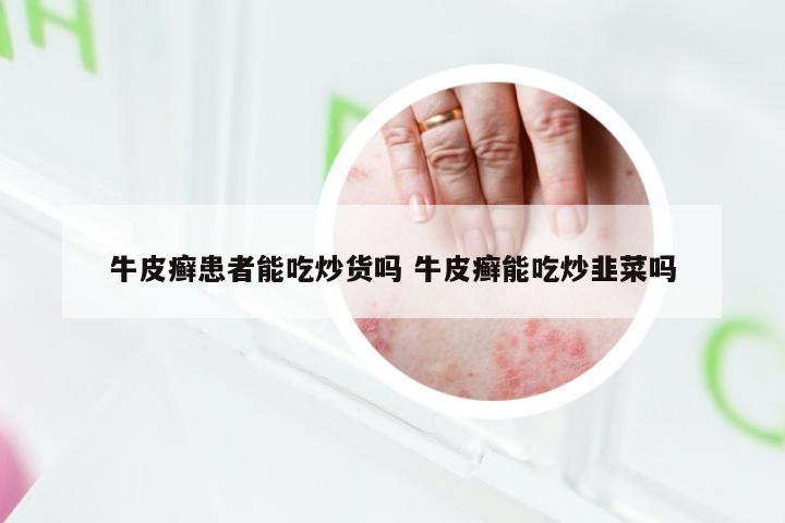 牛皮癣患者能吃炒货吗 牛皮癣能吃炒韭菜吗
