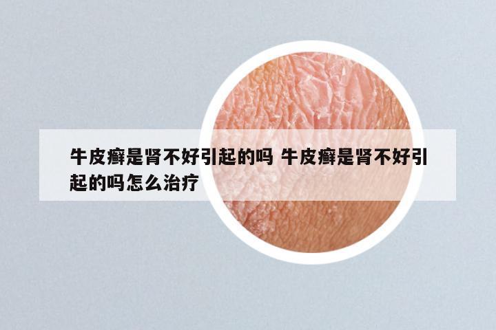 牛皮癣是肾不好引起的吗 牛皮癣是肾不好引起的吗怎么治疗