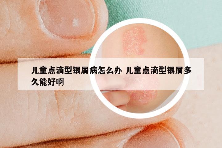 儿童点滴型银屑病怎么办 儿童点滴型银屑多久能好啊