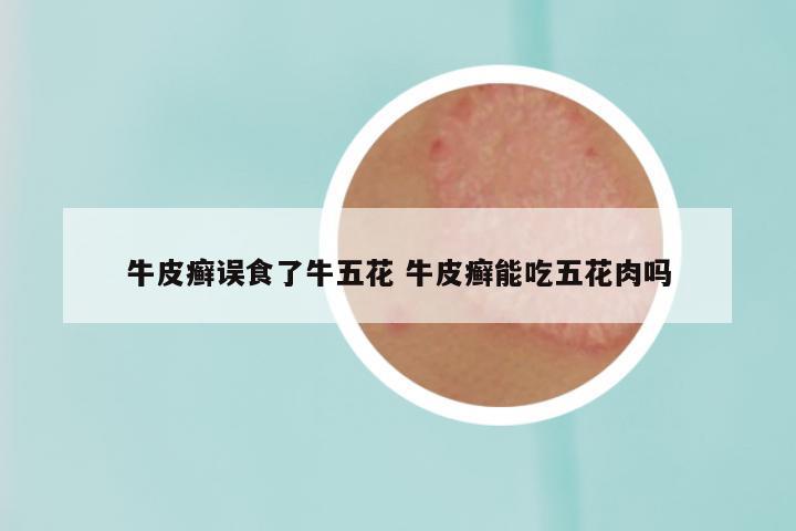 牛皮癣误食了牛五花 牛皮癣能吃五花肉吗