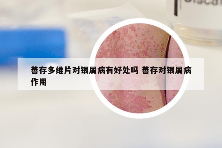 善存多维片对银屑病有好处吗 善存对银屑病作用