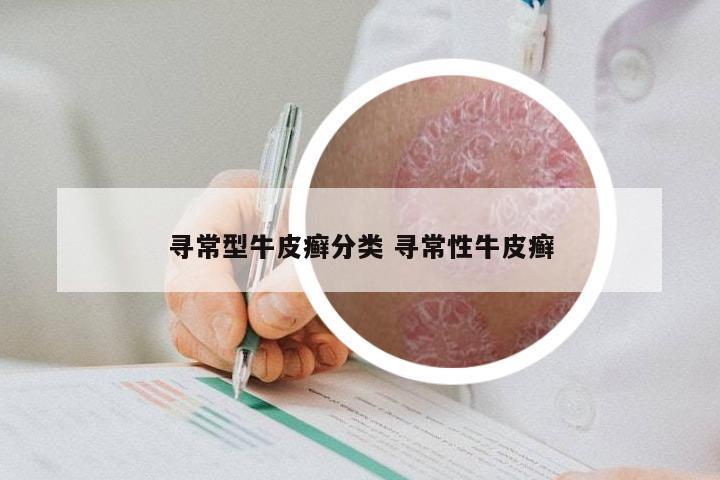 寻常型牛皮癣分类 寻常性牛皮癣