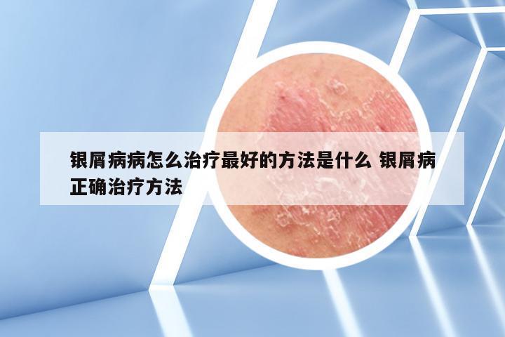 银屑病病怎么治疗最好的方法是什么 银屑病正确治疗方法