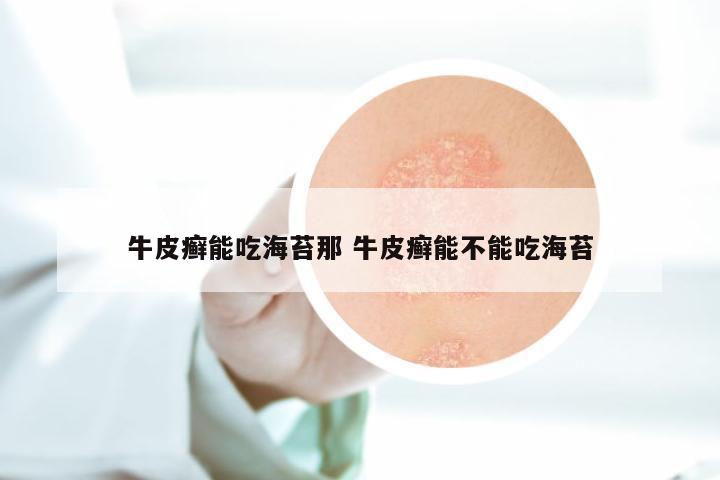牛皮癣能吃海苔那 牛皮癣能不能吃海苔
