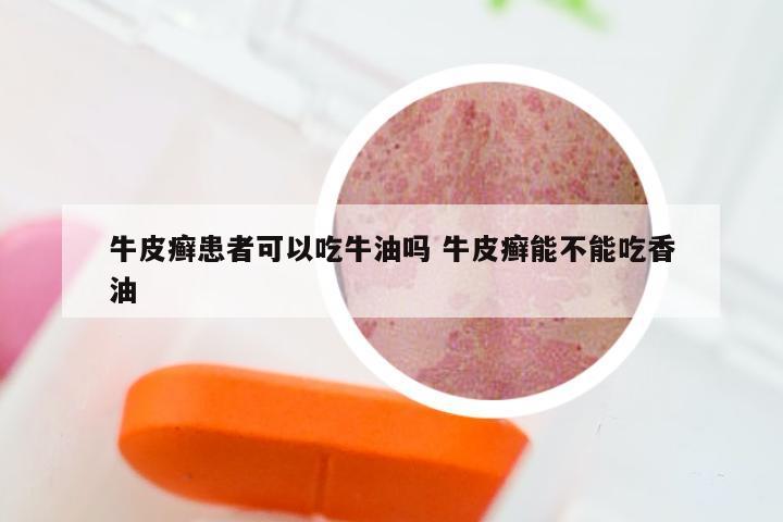 牛皮癣患者可以吃牛油吗 牛皮癣能不能吃香油