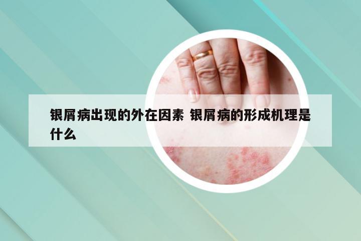 银屑病出现的外在因素 银屑病的形成机理是什么
