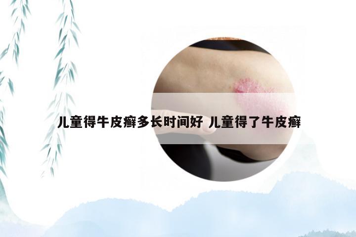 儿童得牛皮癣多长时间好 儿童得了牛皮癣