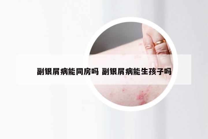副银屑病能同房吗 副银屑病能生孩子吗