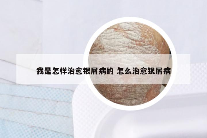 我是怎样治愈银屑病的 怎么治愈银屑病