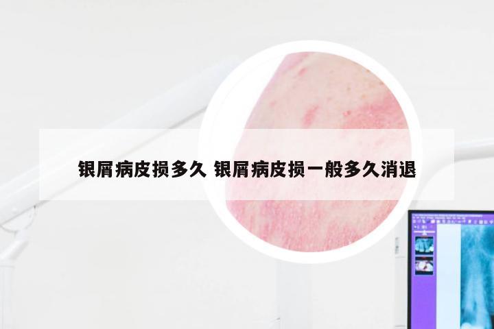银屑病皮损多久 银屑病皮损一般多久消退